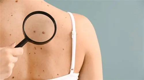 Странная родинка? Вот как вы распознаете возможную меланому
