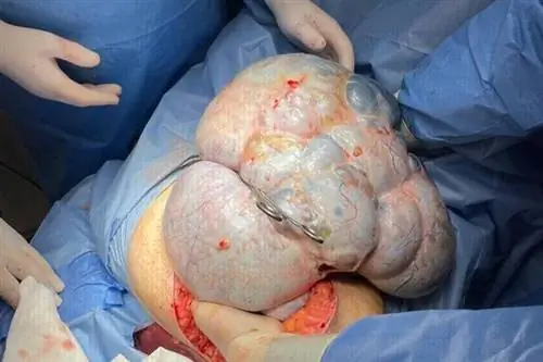 Врачи удалили 11-килограммовую опухоль яичника