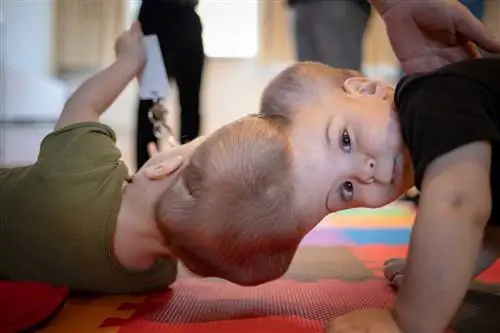 Сиамские близнецы, соединенные разлученным мозгом. Технологии виртуальной реальности помогли