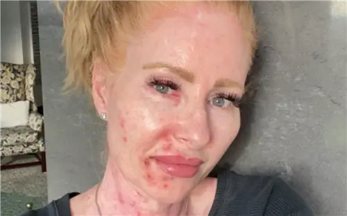 Ее тело покрыто болезненными струпьями, которые невозможно удалить. 53-летняя женщина с раком кожи предупреждает окружающих