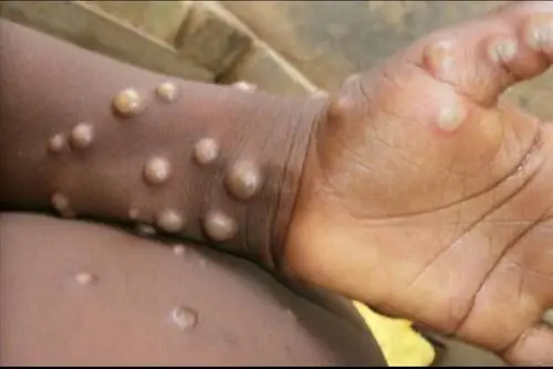 В Европе обнаружена оспа обезьян. В Англии подтвержден случай редкой тропической болезни