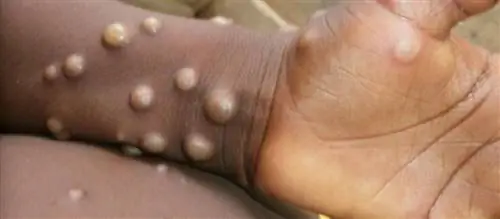 В Европе обнаружена оспа обезьян. В Англии подтвержден случай редкой тропической болезни