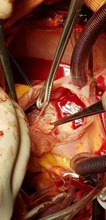 Одномоментная операция по коррекции врожденного дефекта межжелудочковой перегородки и имплантация трехстворчатого клапана из экстрацеллюлярного матрикса CorMatrix