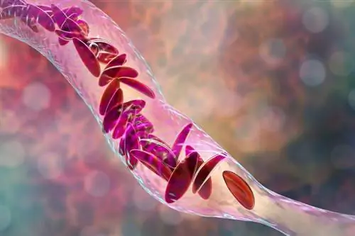 Вазоконстрикция - спазм сосудов