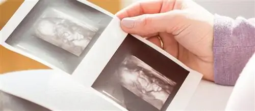 УЗИ показало что-то шокирующее в черепе ребенка. Даже врачи не могли в это поверить