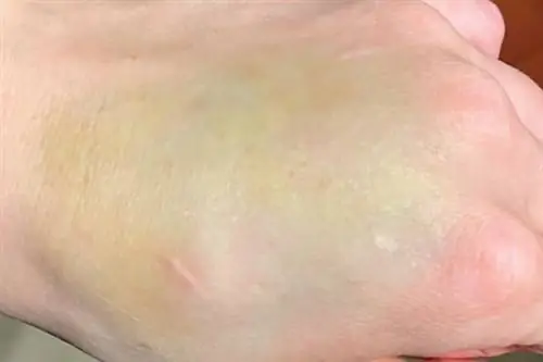 Странный синяк оказался раком. Врачи очень мало знают об этом заболевании