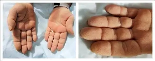 Так выглядят пальцы при ладонном акантозе