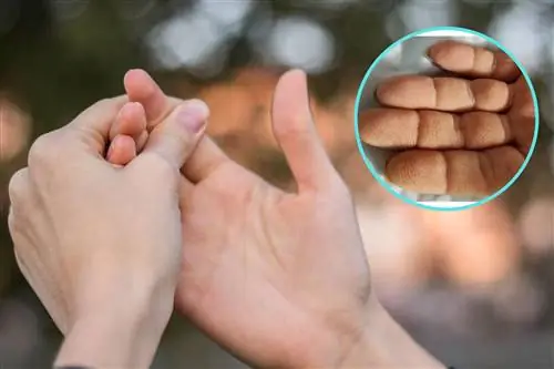 «Пальцы как рубец» сигнализируют об опасных видах рака. Рак легких в списке