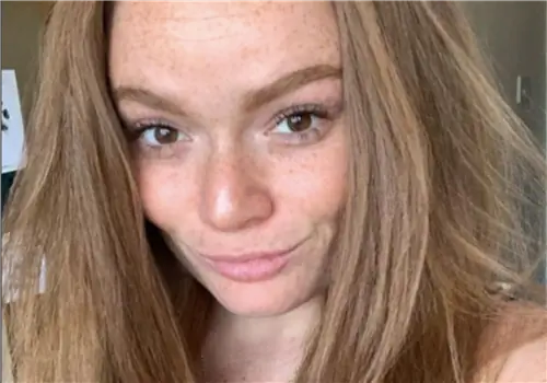 Люди думают, что она все еще пьяна. Побочные эффекты болезни «разрушили ее жизнь»