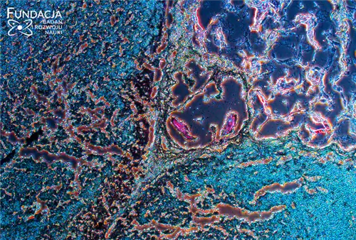 Прогресс в исследованиях по созданию бионической поджелудочной железы