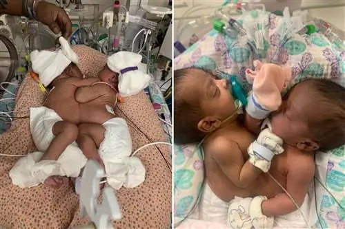 11 часов и 25 врачей. Сиамские близнецы были разделены в ходе «исторической» операции