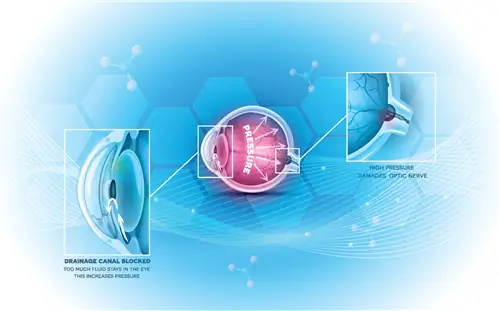 Проф. Марек Ренкас: глаукому нужно контролировать