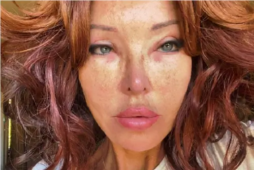 Ева Минге борется с болезнью. Она показала, как она выглядит. «Кожа вокруг глаз трескается, сходит пятнами»
