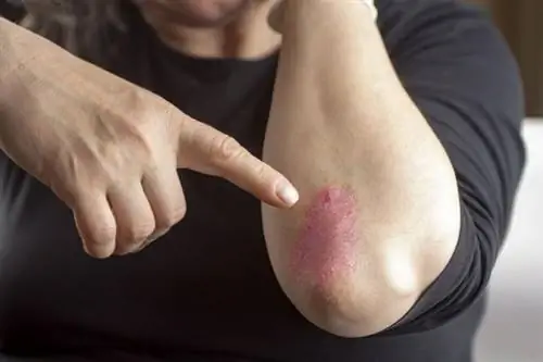 Стоимость лечения псориаза увеличилась. Их можно снизить при скоординированном уходе