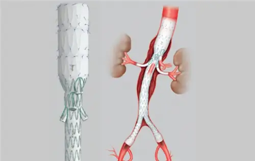 " Рукава" спасли пациента. Впервые в Щецине