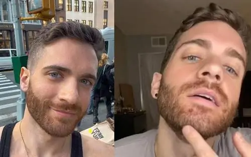 Молодой человек показал себя больным обезьяньей оспой. Отнеситесь к этому вирусу серьезно