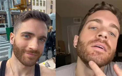 Молодой человек заболел обезьяньей оспой. «Отнеситесь к этому вирусу серьезно»