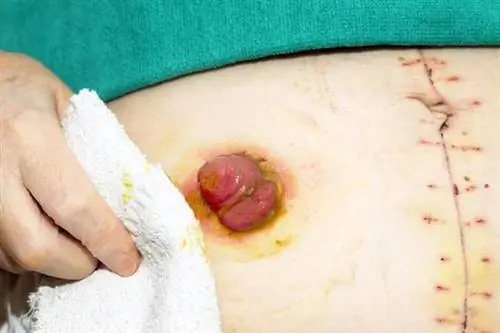 Стома - это свищ, созданный хирургическим путем.