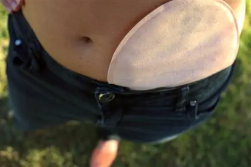 Стома - что это такое? Показания, виды, уход, осложнения