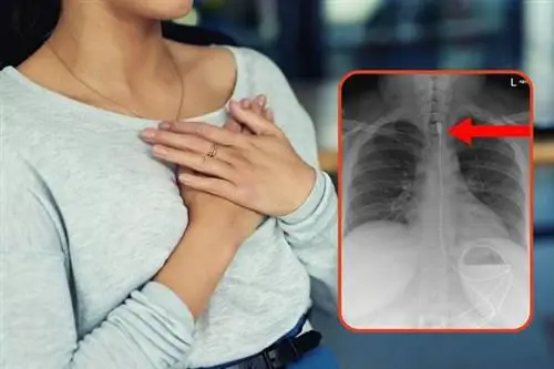 Она попала в отделение неотложной помощи с метровым кабелем в пищеводе. Врачи диагностировали редкое заболевание