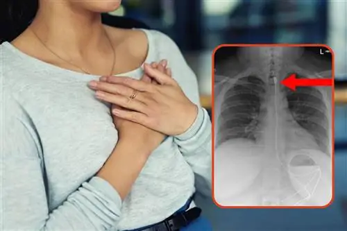 Она попала в отделение неотложной помощи с метровым кабелем в пищеводе. Врачи диагностировали редкое заболевание