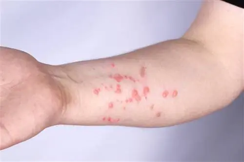 Оспа обезьян - причины, симптомы, диагностика и лечение