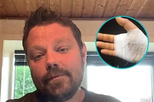 Он был укушен кошкой и заражен плотоядными бактериями. 33-летний мужчина скончался.