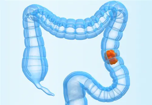 Всемирный день метастатического колоректального рака