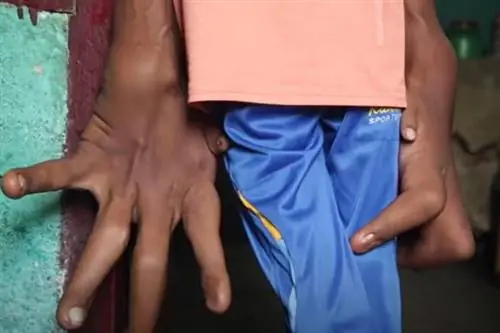 Его руки весят 16 кг. Ему очень больно, но помощи нет. "Дитя дьявола"