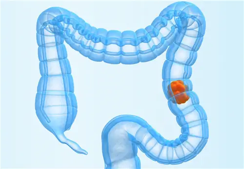 Всемирный день метастатического колоректального рака