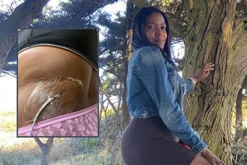 У нее были кисты размером с грейпфрут на яичниках. «Боль забрала мою работу»