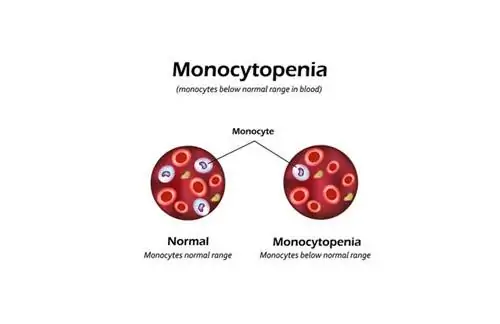 Моноцитопения: причины, симптомы