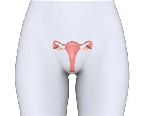 Сужение (атрезия) наружного цервикального отверстия