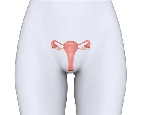 Сужение (атрезия) наружного цервикального отверстия