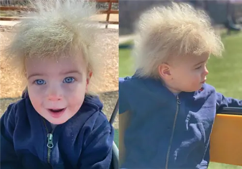 Синдром нерасчесанных волос