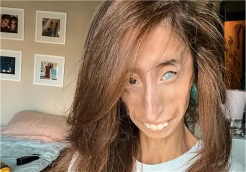 Ее называли «самой уродливой женщиной в мире». Болезнь деформировала ее лицо и тело