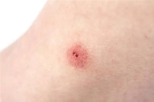 Комариный укус