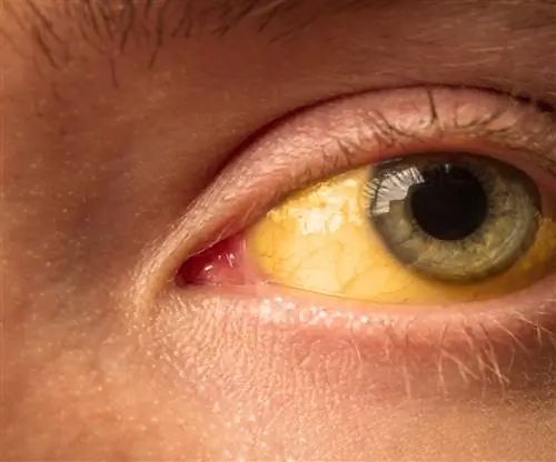 Необычные побочные эффекты ингредиента популярных обезболивающих. Среди них: пожелтение белков глаз