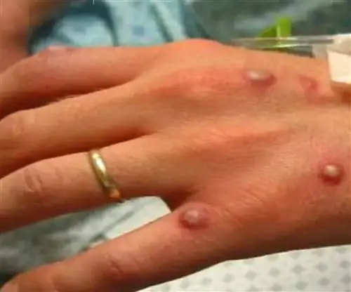 Вот так выглядит сыпь от обезьяньей оспы. Как ее узнать?