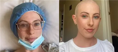 23-летняя девушка приняла опухоль за прыщ: никогда не думала, что мне грозит рак, тем более в моем возрасте