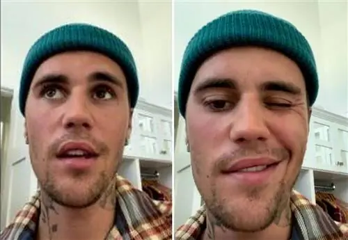 Джастин Бибер страдает синдромом Рамзи Ханта. У него частично парализованное лицо