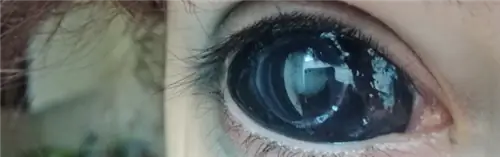 глаз-p.webp