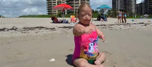 Живу с синдромом Робертса: "Врачи не дали ей шанса выжить, мы должны были взять кровь у мертвого ребенка"