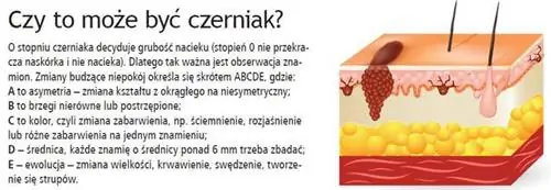 Может это меланома?