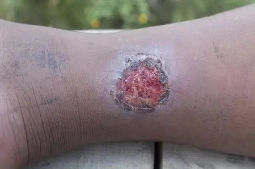 Язва Бурули: причины, симптомы, лечение