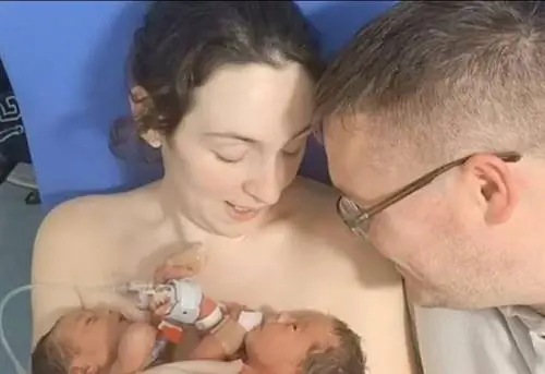 Лечение бесплодия дало удивительный эффект. родились сиамские близнецы