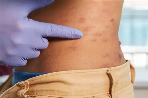 Опоясывающий лишай