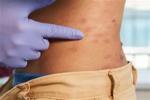 Опоясывающий лишай «просыпается» после перенесенного COVID-19. Эта возрастная группа подвергается наибольшему риску