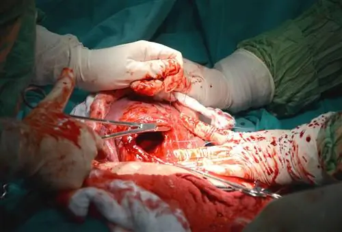 Разрыв матки: причины, симптомы, лечение