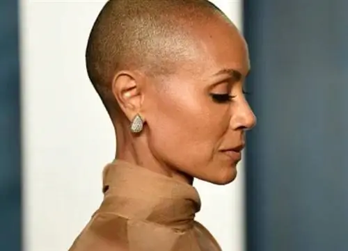 Не только Джада Пинкетт-Смит, тысячи людей страдают алопецией. Поможет ли им лекарство от артрита?